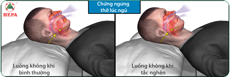 chứng ngưng thở khi ngủ