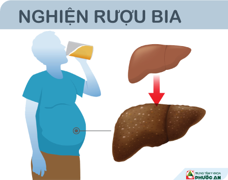 nghien-ruou-bia-xo-gan