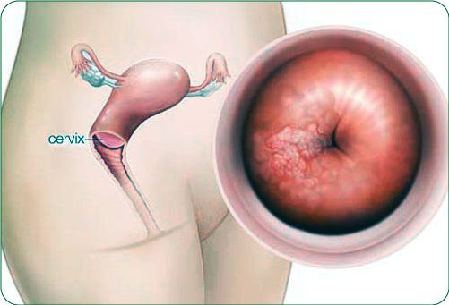 ung thư cổ từ cung có thể ngăn chặn