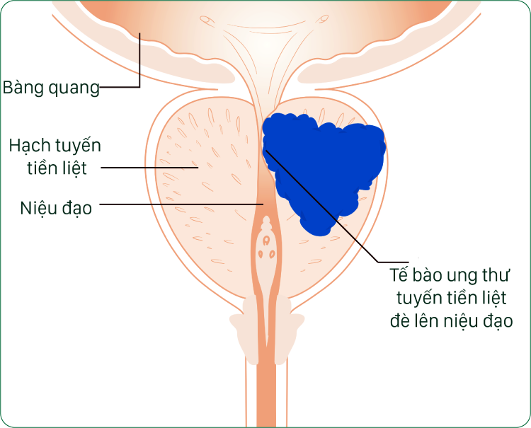 ung thư tuyến tiền liệt
